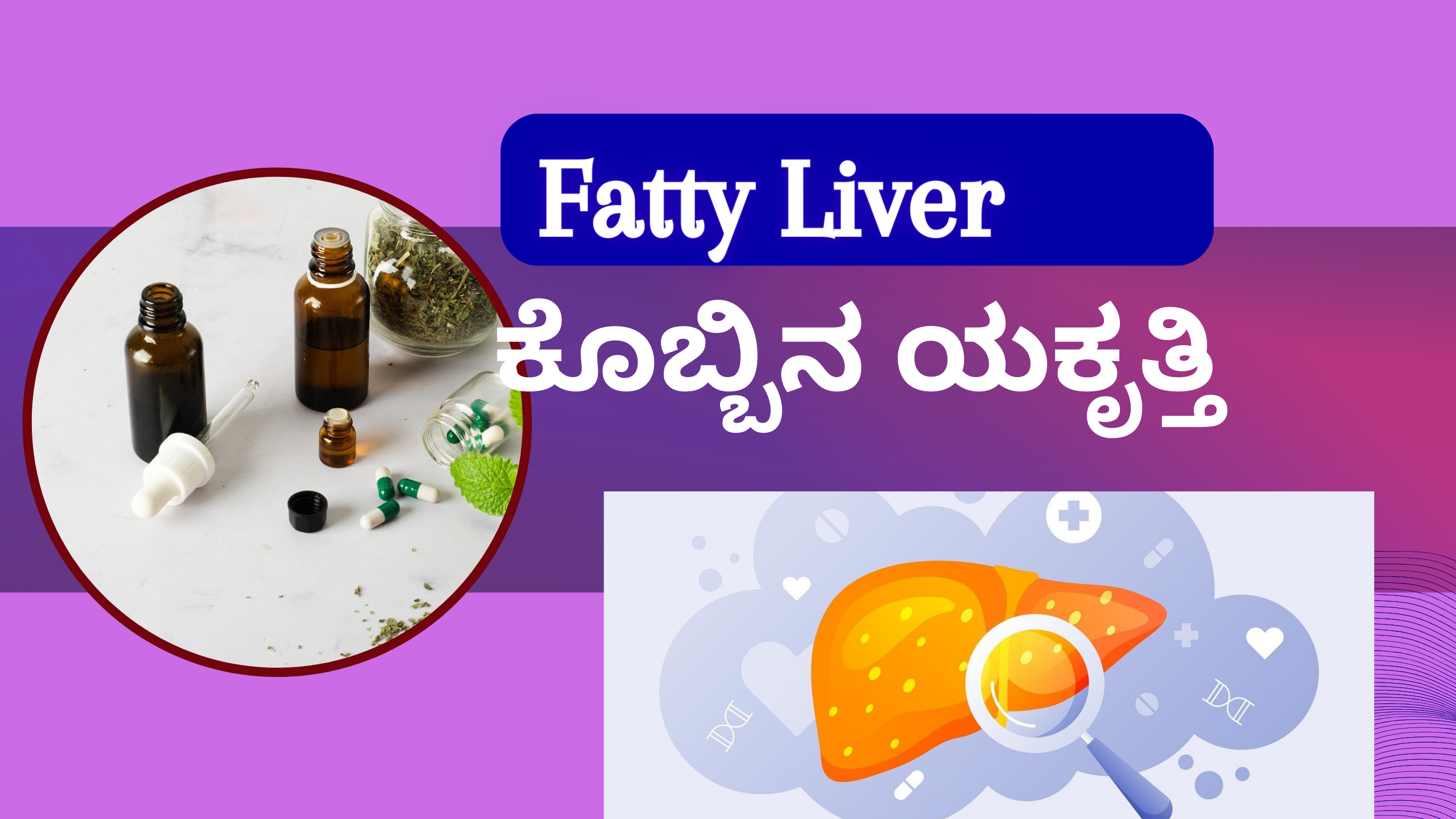 fatty liver